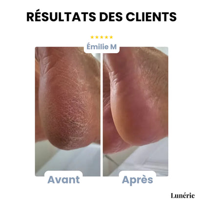 HeelEase™ – Talons Secs & Crevassés ? Solution Express en 1 Minute
