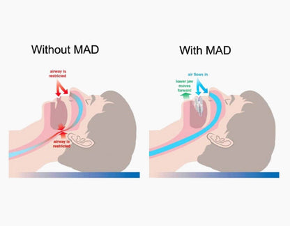 SilentNose® Pince Nasale Anti-Ronflement – Solution Discrète & Efficace